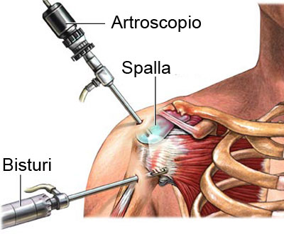 Artroscopia
