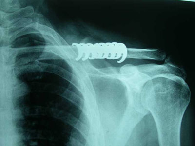 Frattura della clavicola - Placche