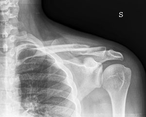 Frattura della clavicola