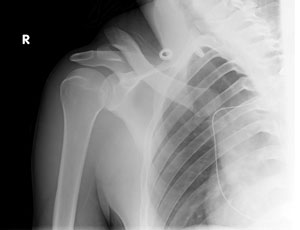 Frattura della clavicola