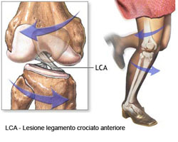 LCA Lesione Legamento Crociato Anteriore